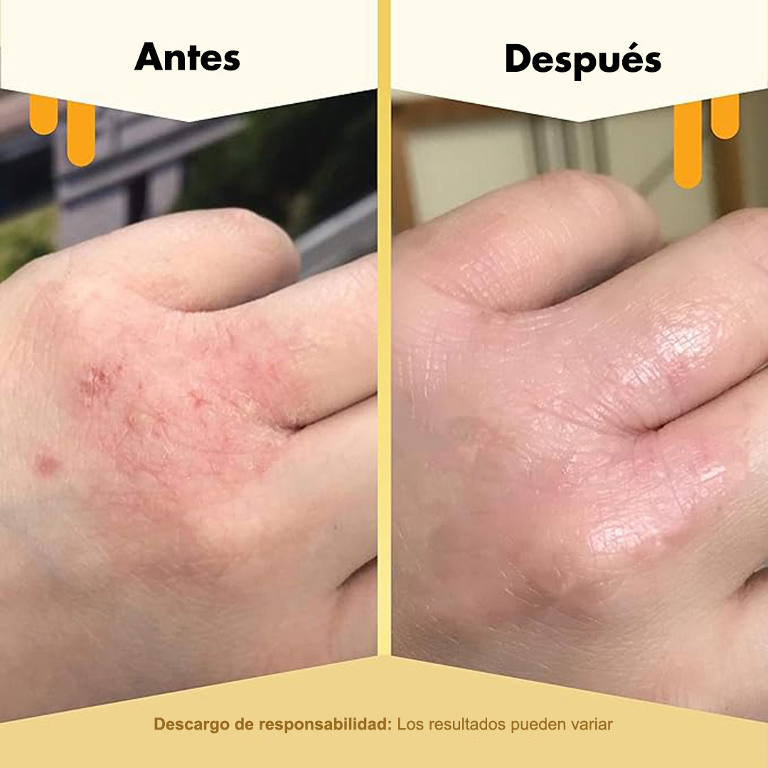 AUREORAN Eczema  | Crema calmante de miel para Eczema